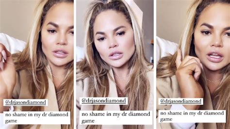 buccal fat removal celebrities|Chrissy Teigen Had Bucca Fat Removal — Heres What It Is